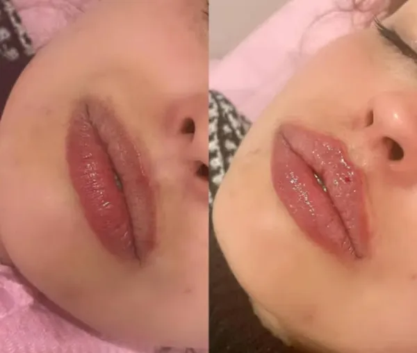 Lips before (left) and after (right) dermal filler